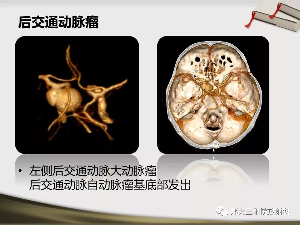 【PPT】头颈联合CTA临床应用