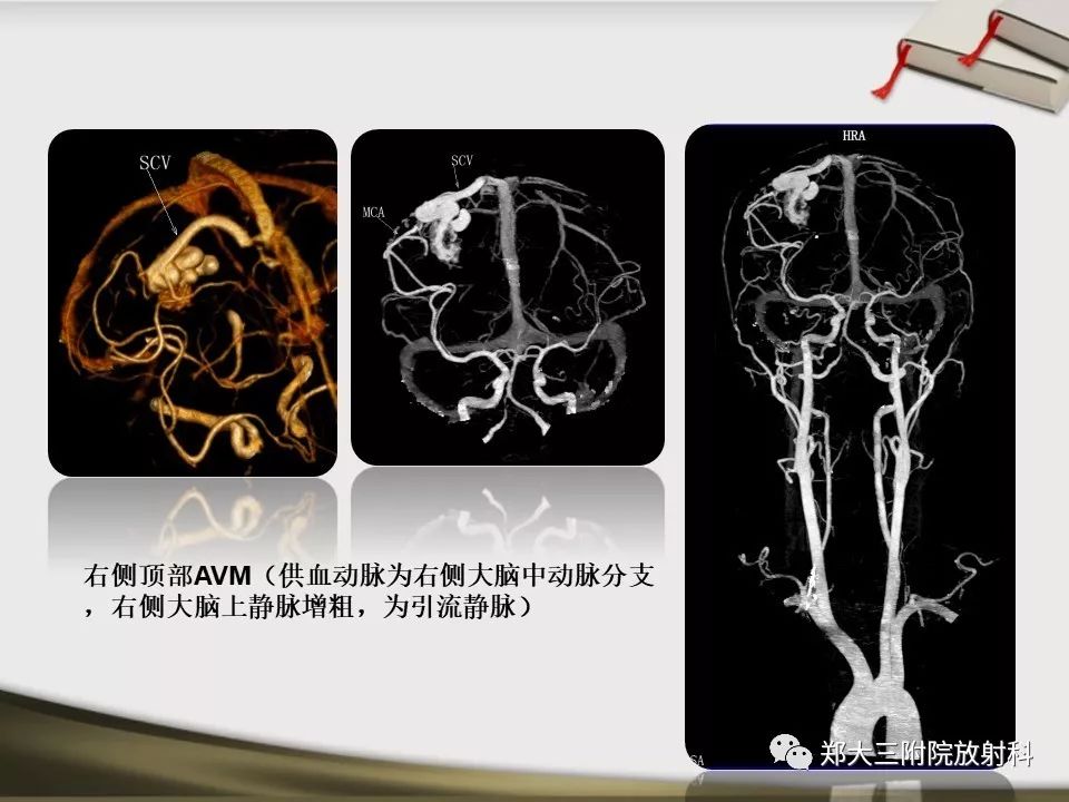 【PPT】头颈联合CTA临床应用