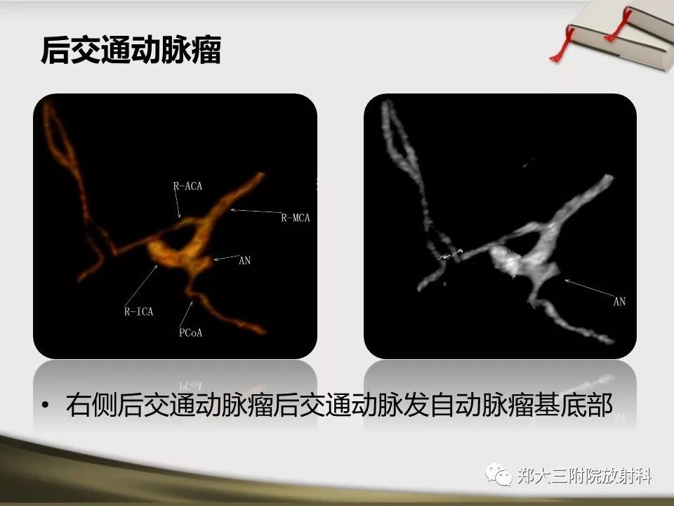 【PPT】头颈联合CTA临床应用