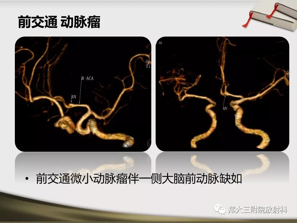 【PPT】头颈联合CTA临床应用