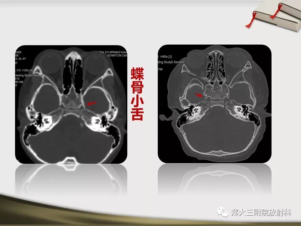 【PPT】头颈联合CTA临床应用
