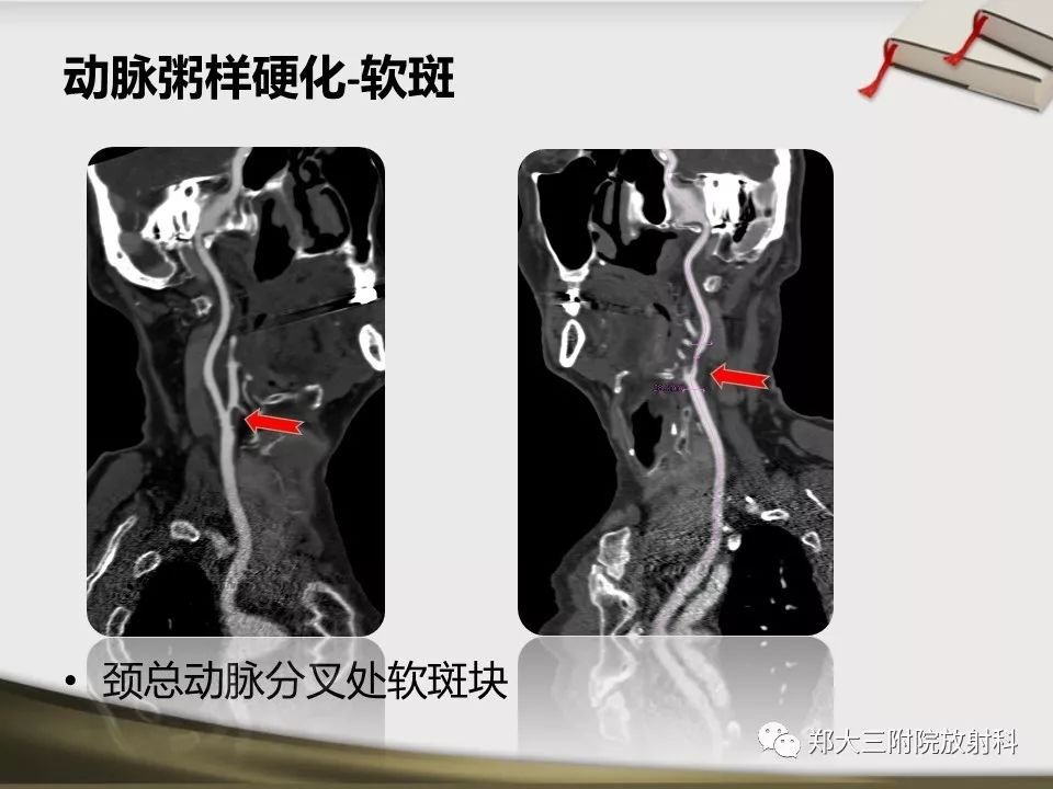 【PPT】头颈联合CTA临床应用