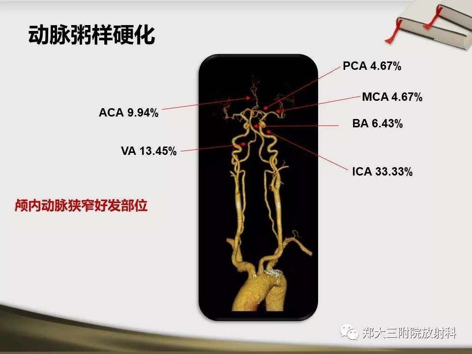 【PPT】头颈联合CTA临床应用