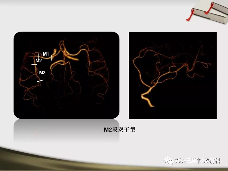 【PPT】头颈联合CTA临床应用