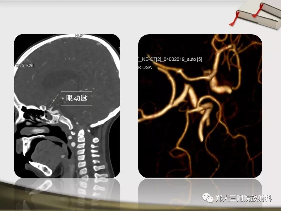 【PPT】头颈联合CTA临床应用