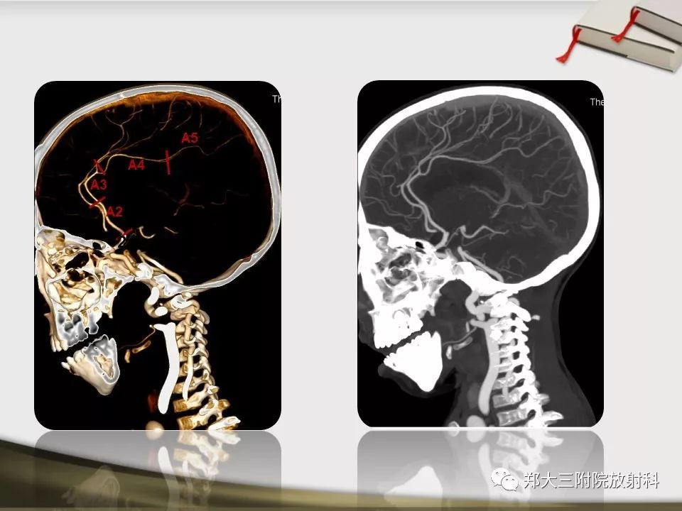 【PPT】头颈联合CTA临床应用