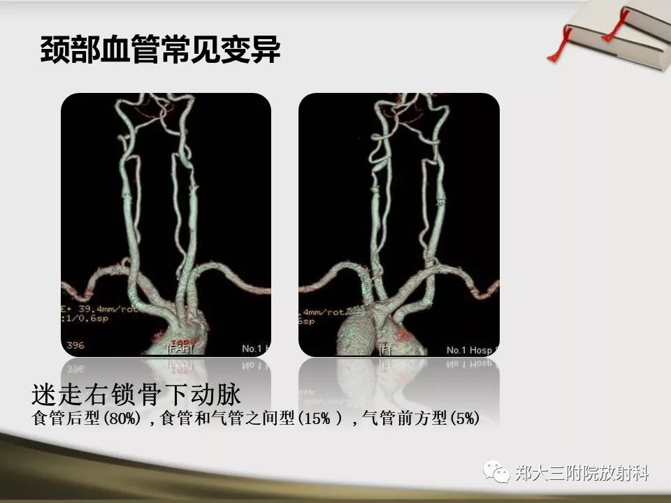 【PPT】头颈联合CTA临床应用
