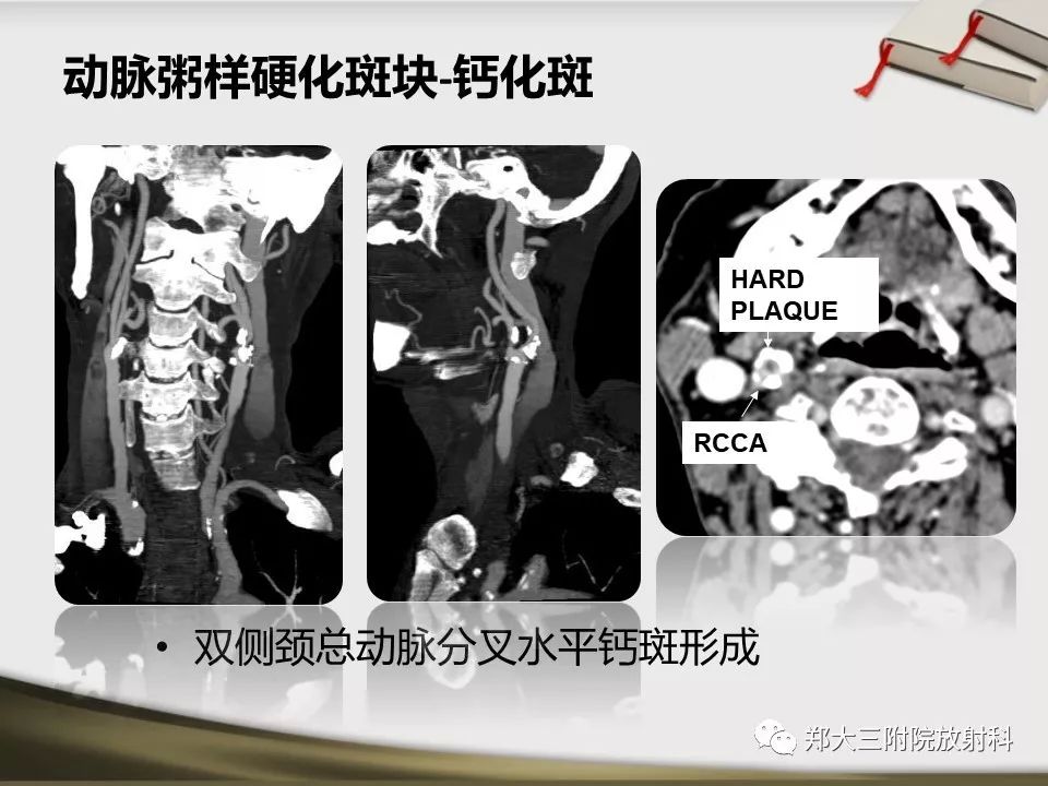 【PPT】头颈联合CTA临床应用