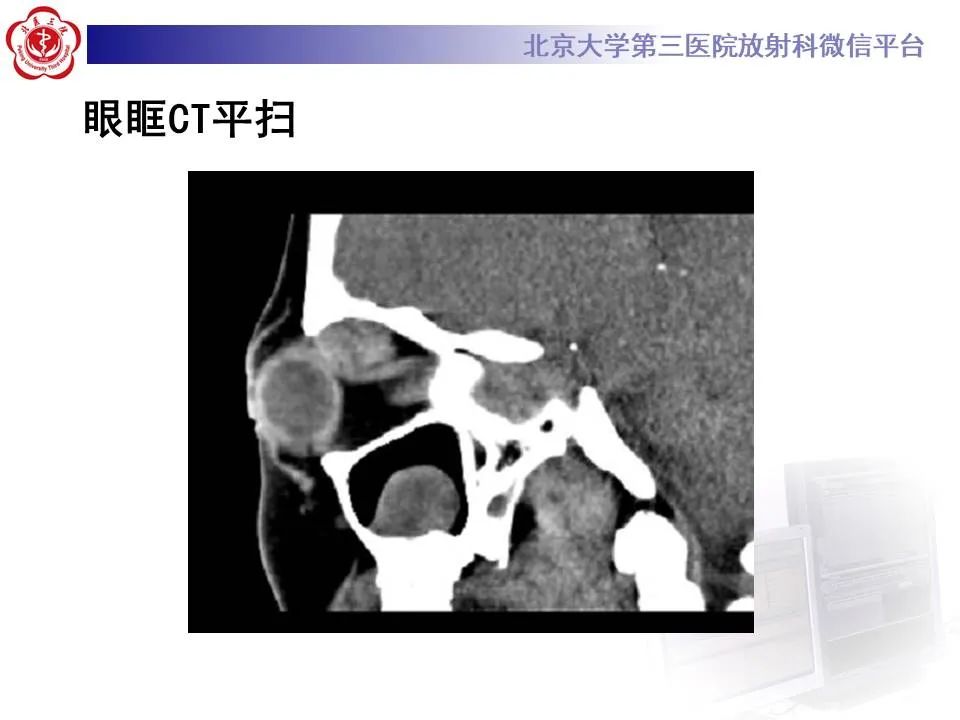 【PPT】眶内海绵状血管瘤