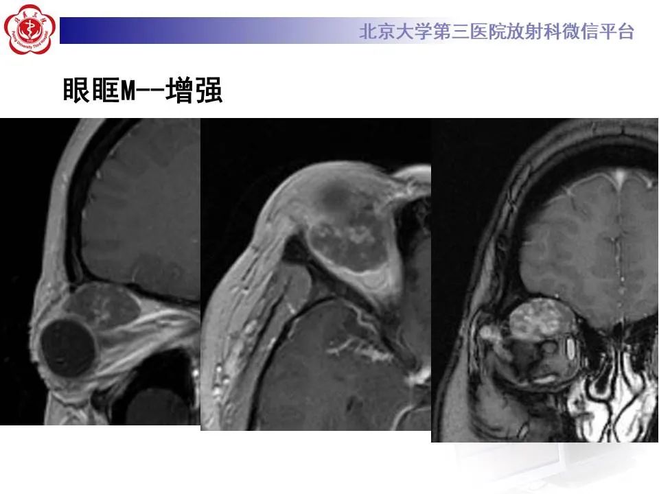 【PPT】眶内海绵状血管瘤
