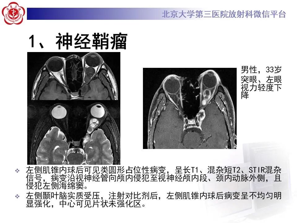 【PPT】眶内海绵状血管瘤