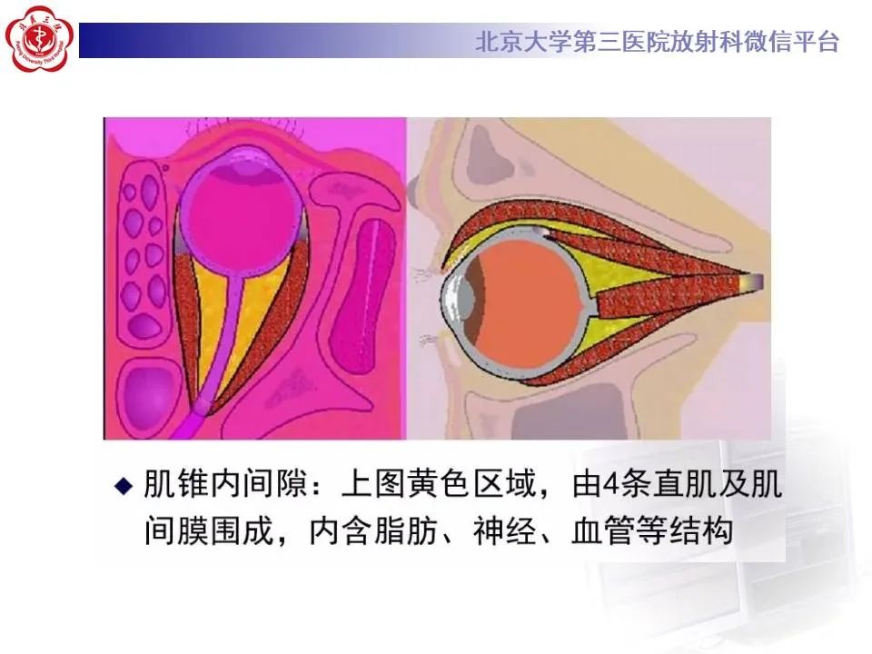 【PPT】眶内海绵状血管瘤