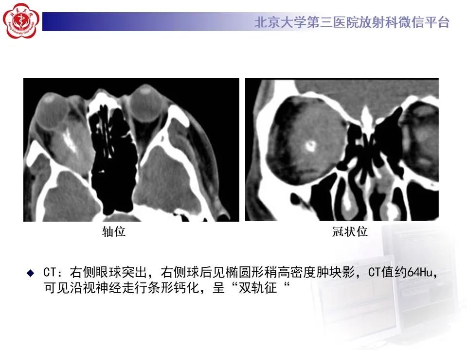 【PPT】眶内海绵状血管瘤