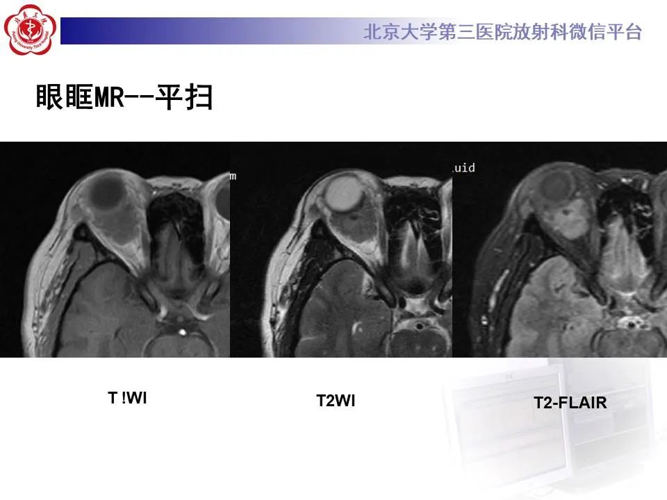 【PPT】眶内海绵状血管瘤