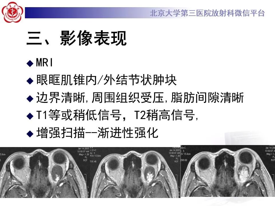 【PPT】眶内海绵状血管瘤