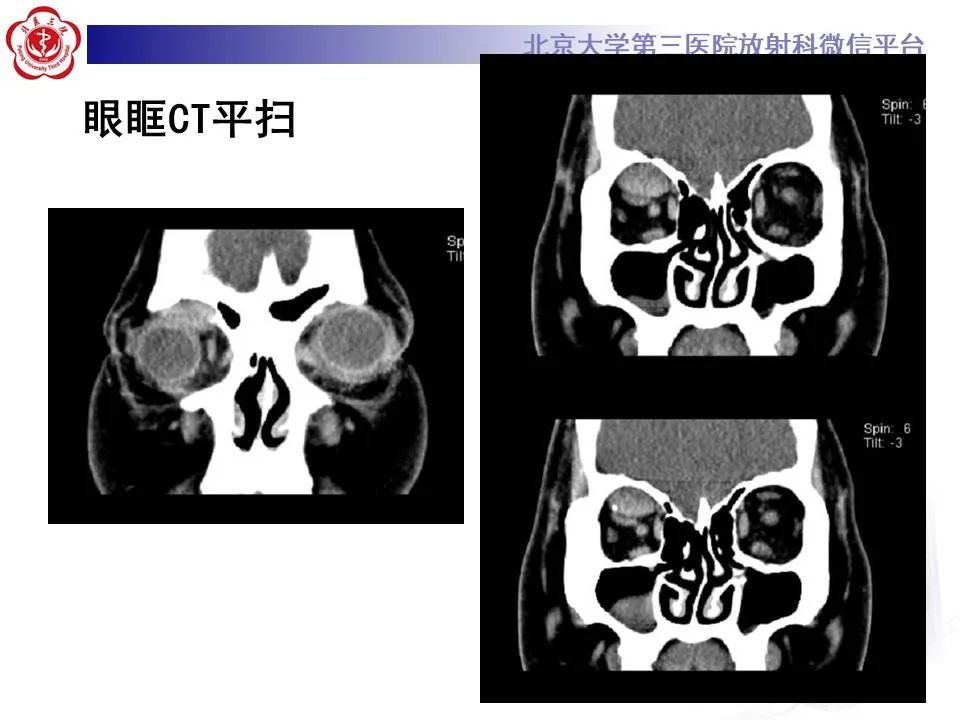 【PPT】眶内海绵状血管瘤