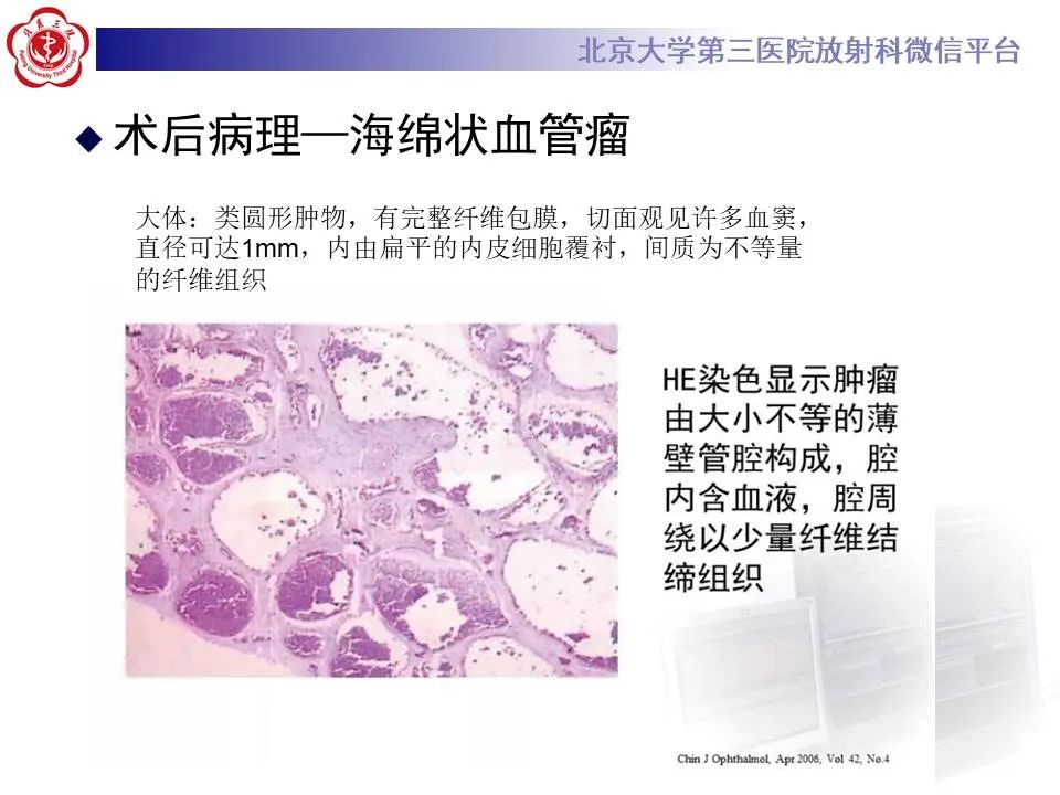 【PPT】眶内海绵状血管瘤