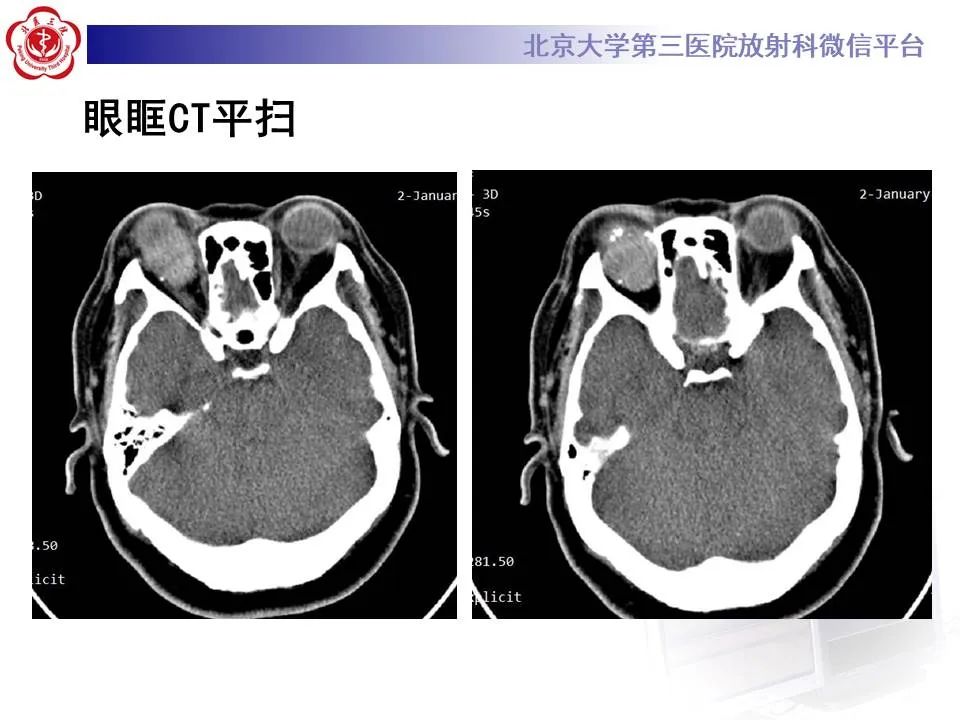 【PPT】眶内海绵状血管瘤
