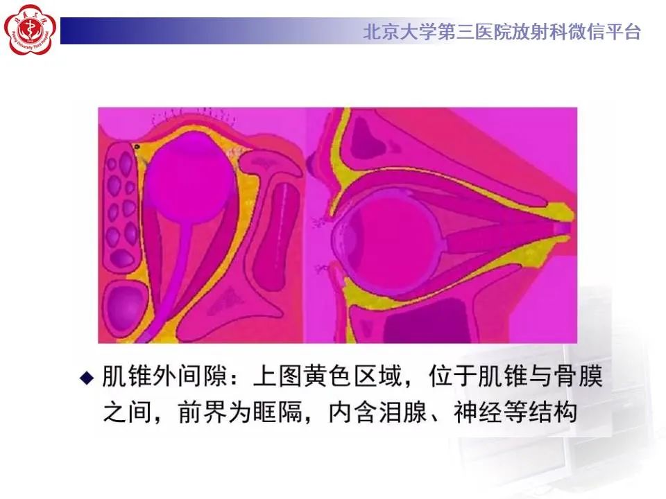 【PPT】眶内海绵状血管瘤