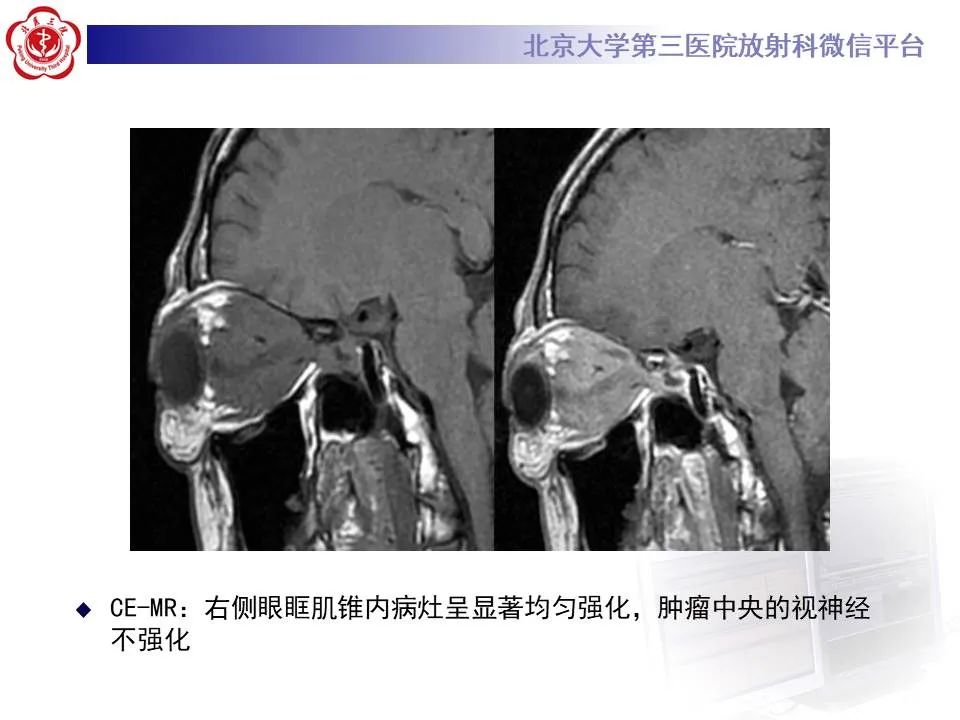 【PPT】眶内海绵状血管瘤