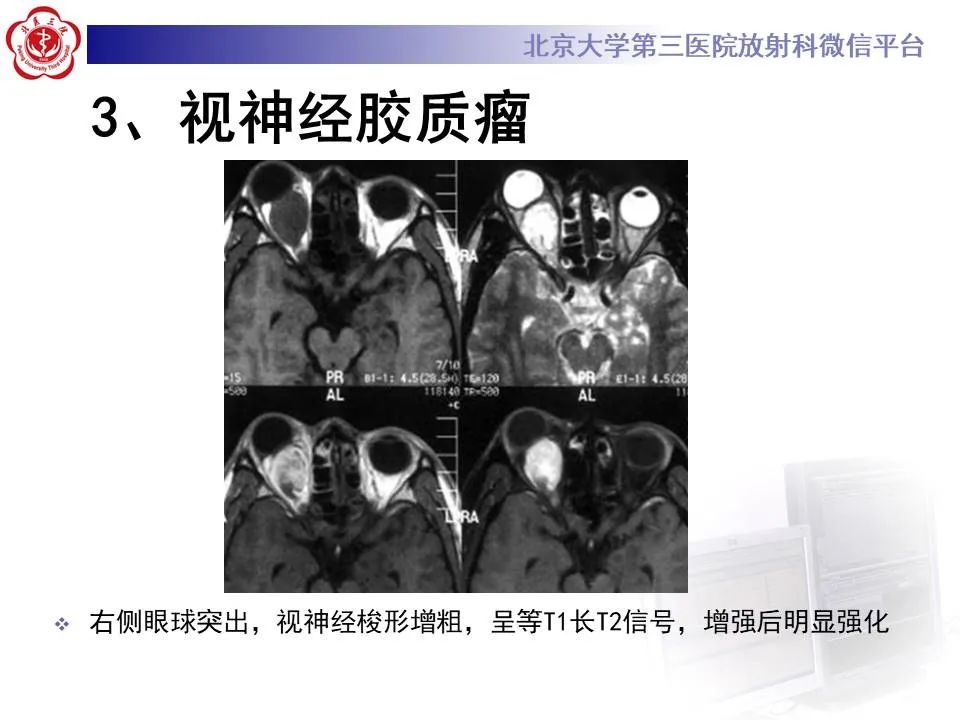 【PPT】眶内海绵状血管瘤