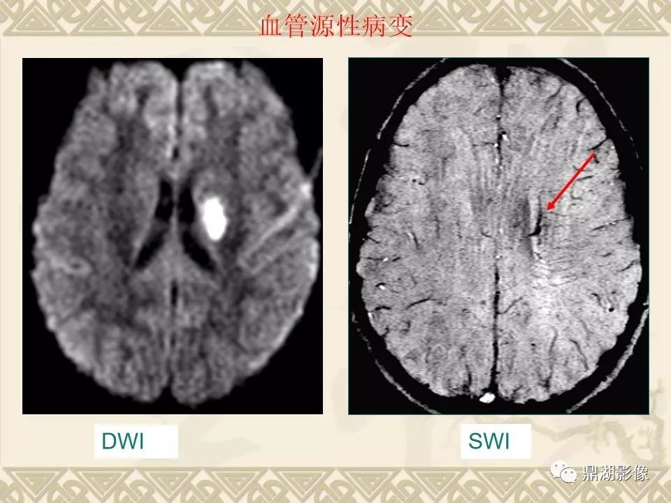 【PPT】SWI（磁敏感加权成像）在中枢神经系统疾病的应用