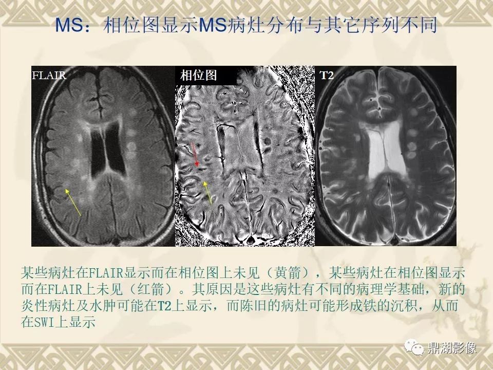 【PPT】SWI（磁敏感加权成像）在中枢神经系统疾病的应用