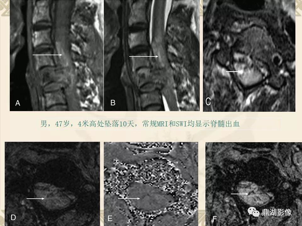 【PPT】SWI（磁敏感加权成像）在中枢神经系统疾病的应用