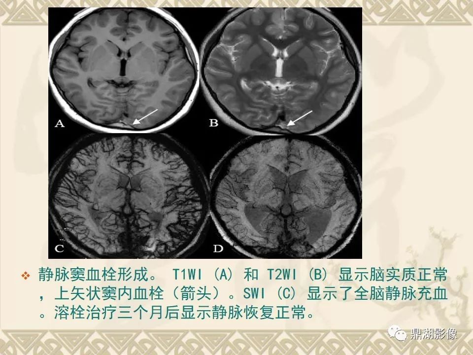 【PPT】SWI（磁敏感加权成像）在中枢神经系统疾病的应用