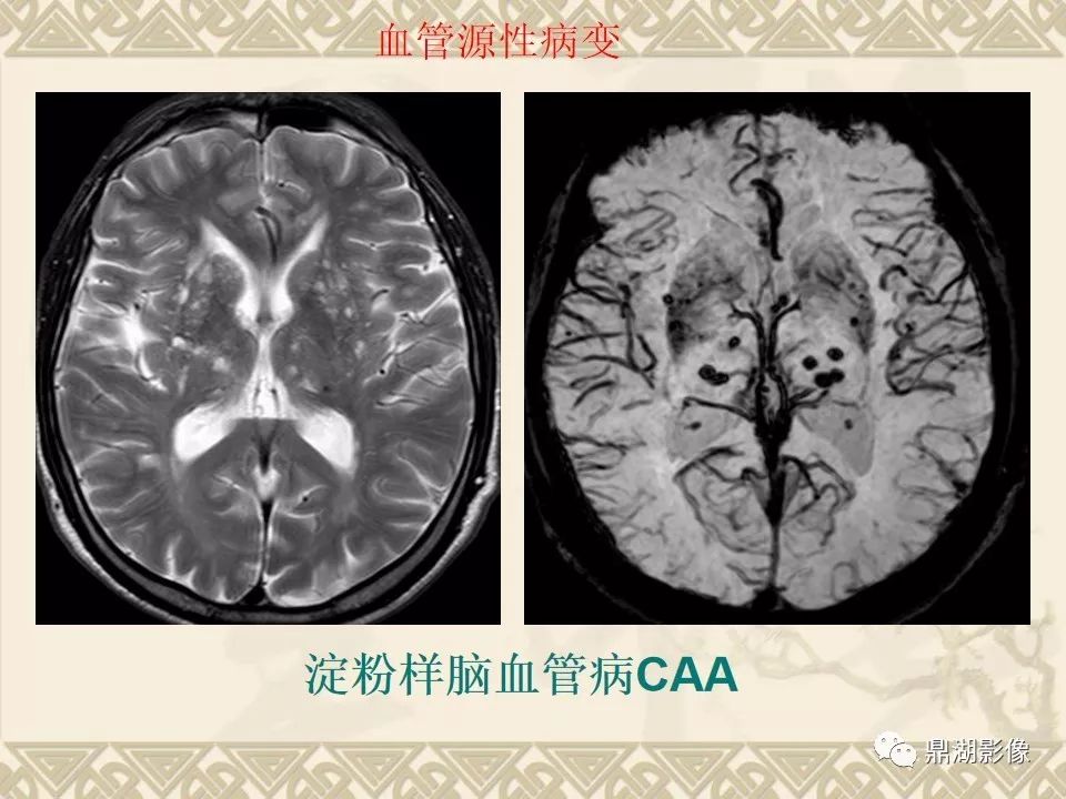【PPT】SWI（磁敏感加权成像）在中枢神经系统疾病的应用