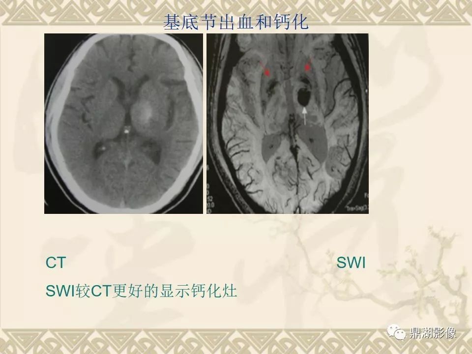 【PPT】SWI（磁敏感加权成像）在中枢神经系统疾病的应用