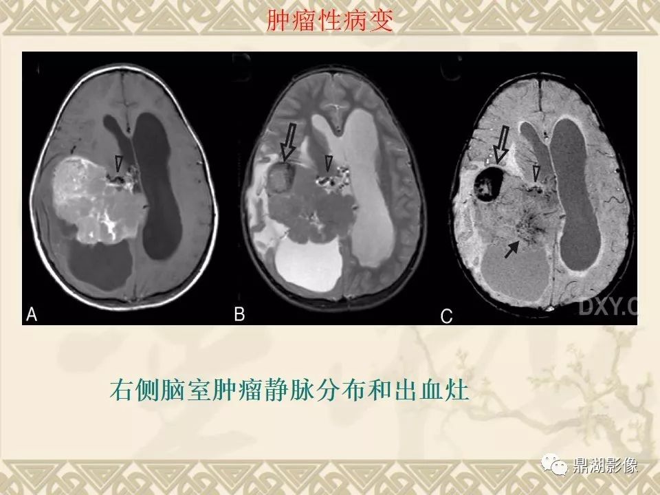 【PPT】SWI（磁敏感加权成像）在中枢神经系统疾病的应用