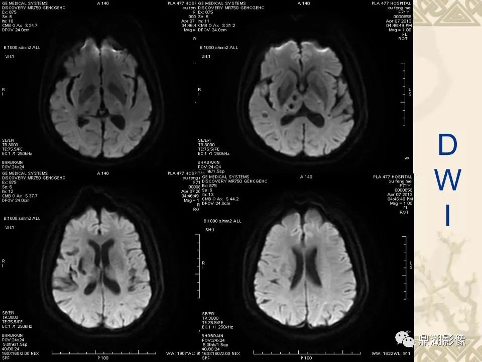 【PPT】SWI（磁敏感加权成像）在中枢神经系统疾病的应用