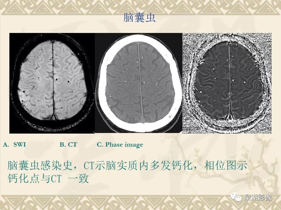 【PPT】SWI（磁敏感加权成像）在中枢神经系统疾病的应用