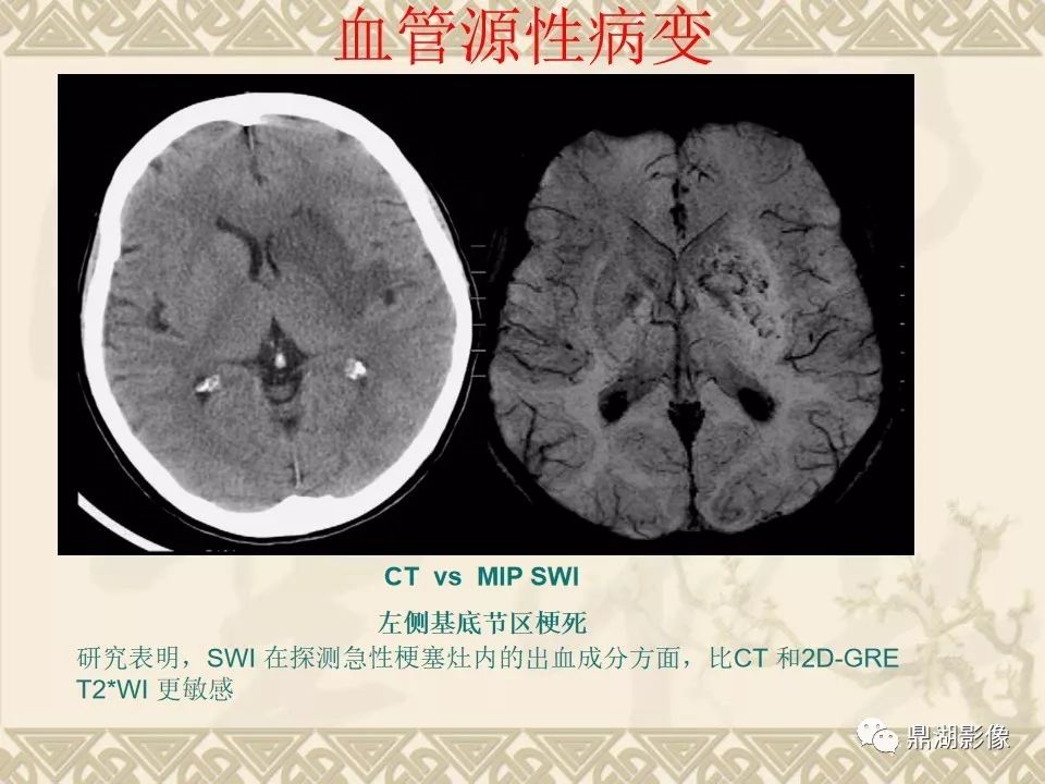 【PPT】SWI（磁敏感加权成像）在中枢神经系统疾病的应用