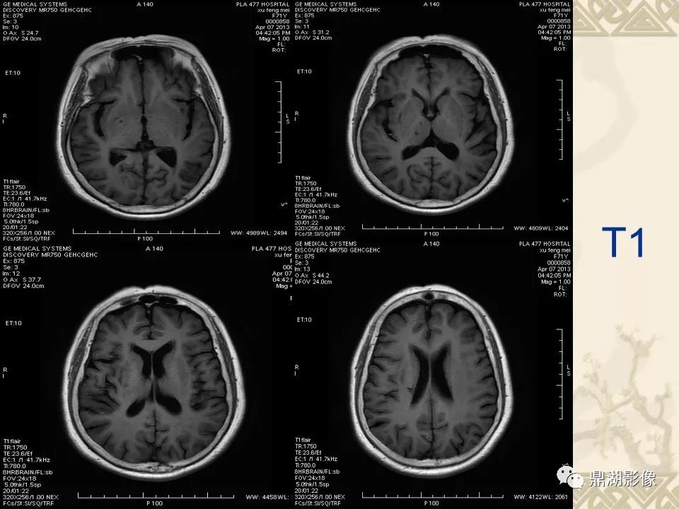 【PPT】SWI（磁敏感加权成像）在中枢神经系统疾病的应用
