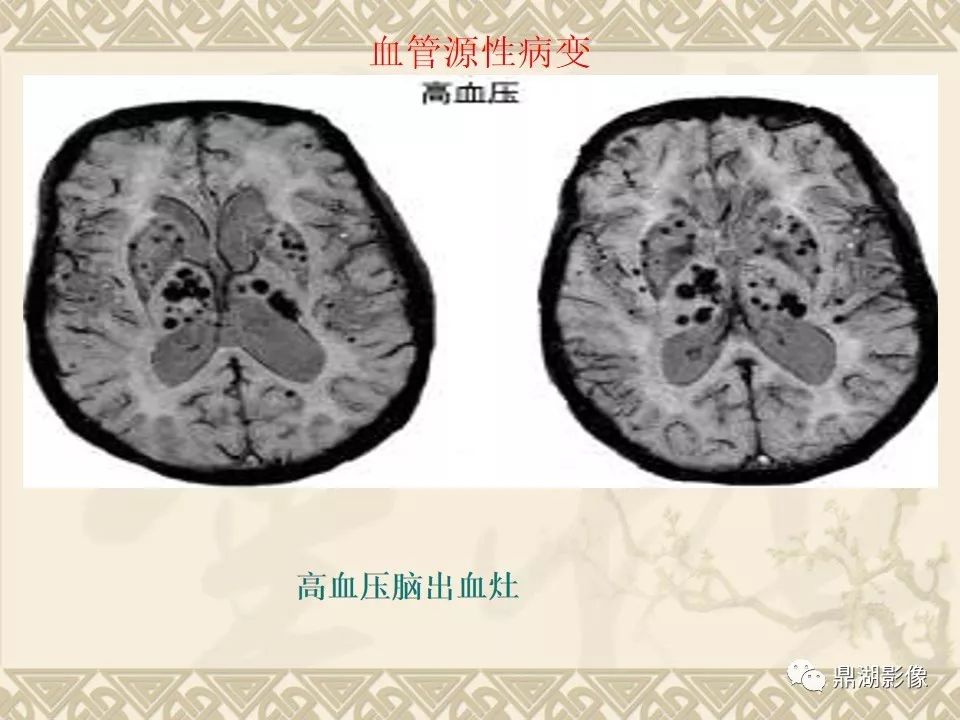 【PPT】SWI（磁敏感加权成像）在中枢神经系统疾病的应用