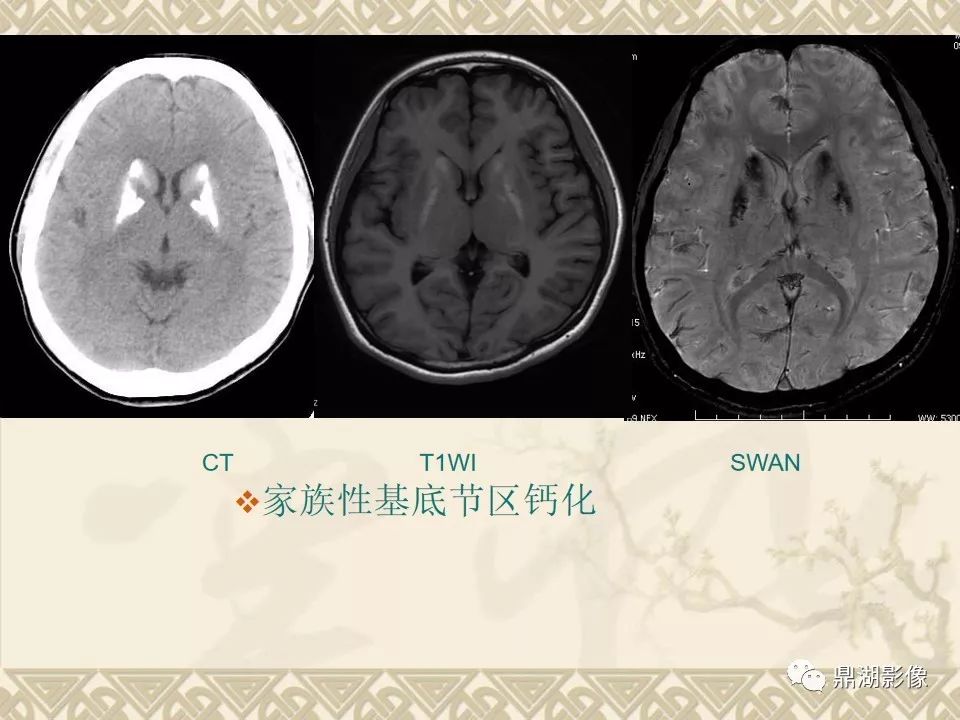 【PPT】SWI（磁敏感加权成像）在中枢神经系统疾病的应用