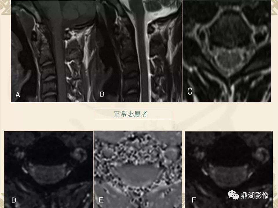 【PPT】SWI（磁敏感加权成像）在中枢神经系统疾病的应用