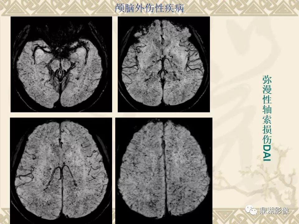 【PPT】SWI（磁敏感加权成像）在中枢神经系统疾病的应用