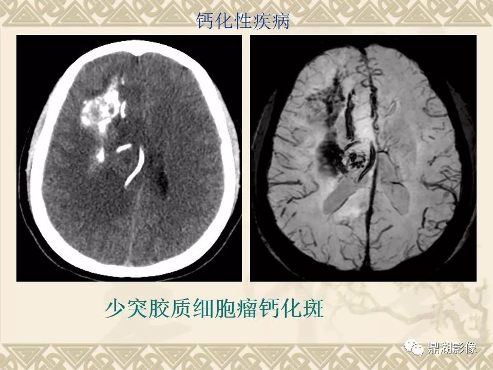 【PPT】SWI（磁敏感加权成像）在中枢神经系统疾病的应用