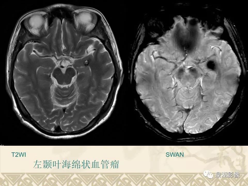 【PPT】SWI（磁敏感加权成像）在中枢神经系统疾病的应用