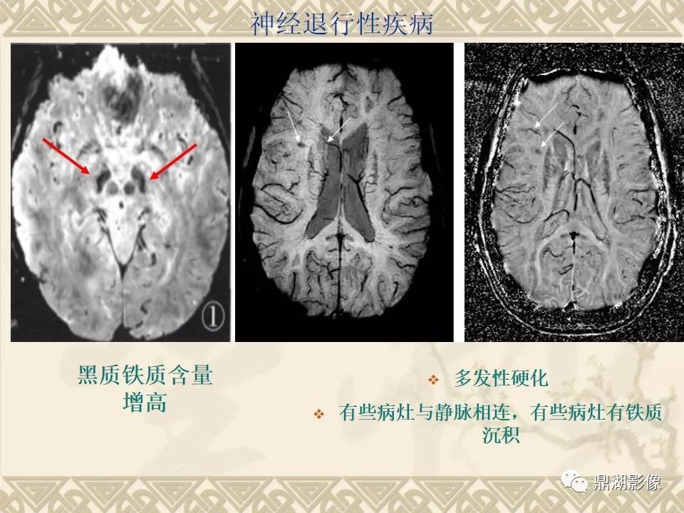 【PPT】SWI（磁敏感加权成像）在中枢神经系统疾病的应用