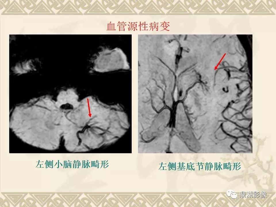 【PPT】SWI（磁敏感加权成像）在中枢神经系统疾病的应用