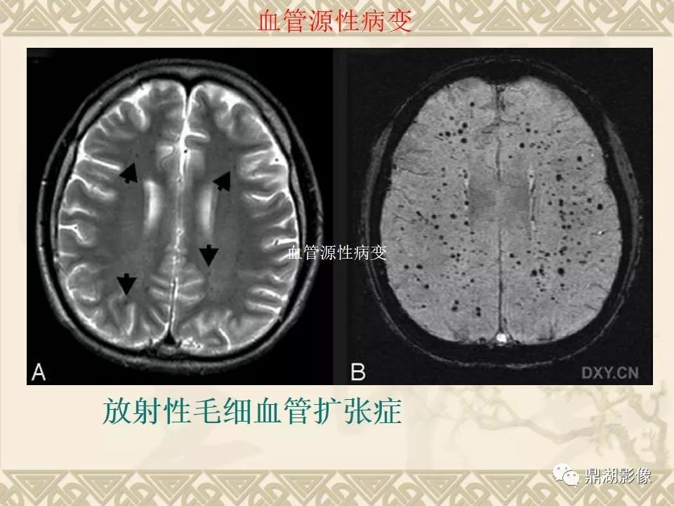 【PPT】SWI（磁敏感加权成像）在中枢神经系统疾病的应用