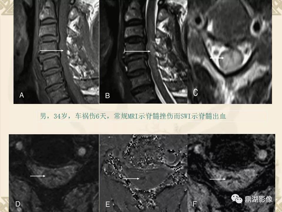 【PPT】SWI（磁敏感加权成像）在中枢神经系统疾病的应用