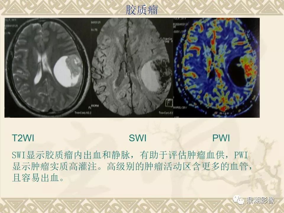 【PPT】SWI（磁敏感加权成像）在中枢神经系统疾病的应用