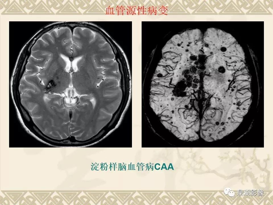 【PPT】SWI（磁敏感加权成像）在中枢神经系统疾病的应用