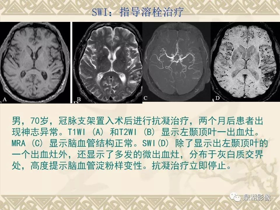 【PPT】SWI（磁敏感加权成像）在中枢神经系统疾病的应用