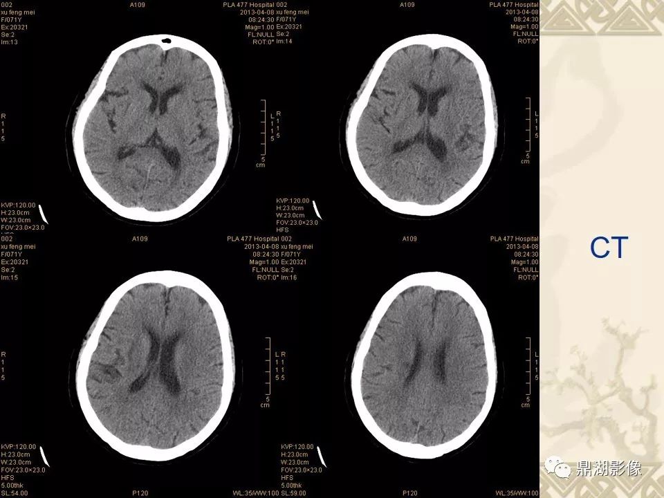 【PPT】SWI（磁敏感加权成像）在中枢神经系统疾病的应用